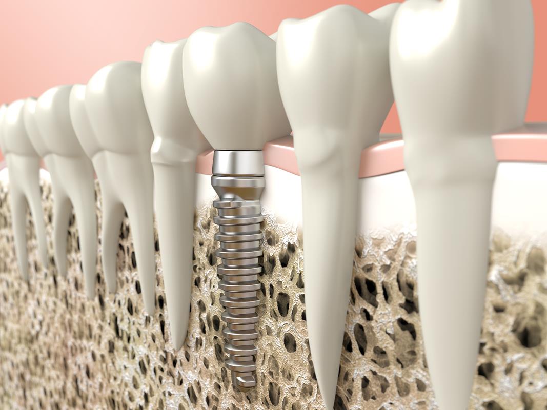 Dental Implants San Jose, CA
