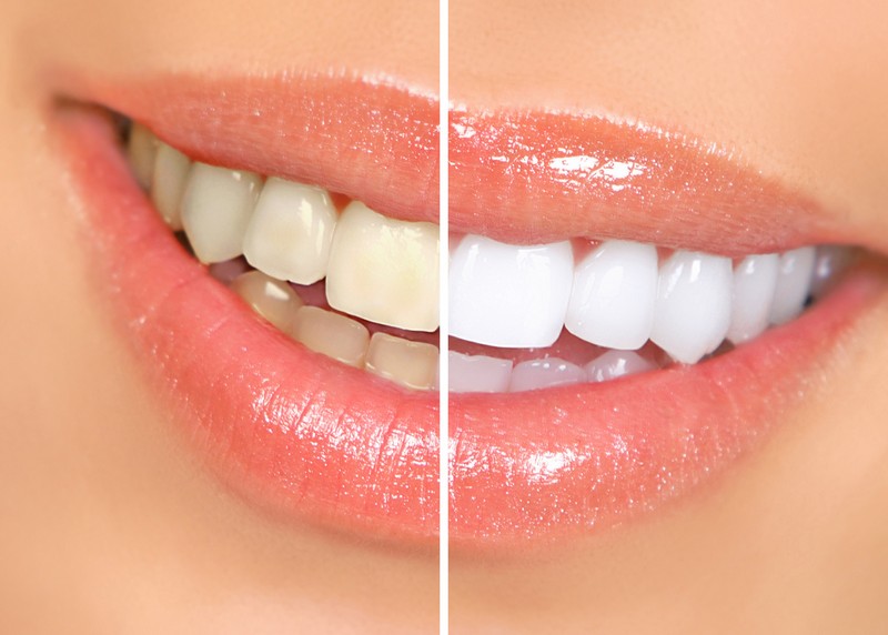 Teeth Whitening San Jose, CA