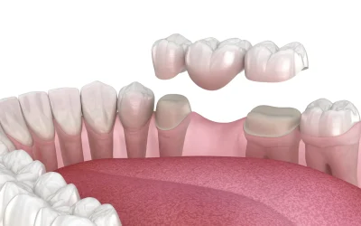 Dental Bridges_result