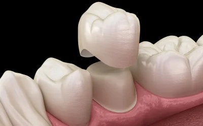 Dental Crowns _result
