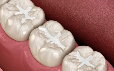Molar Fissure dental fillings, Medically accurate 3D illustration of dental concept
