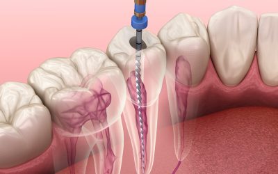 Endodontic root canal treatment process. Medically accurate tooth 3D illustration.