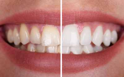 Close-up Of A Smiling Woman's Teeth Before And After Whitening