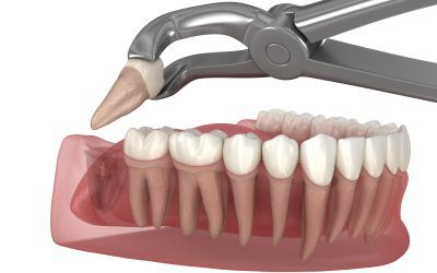 Extraction of wisdom tooth. Medically accurate tooth 3D illustration.